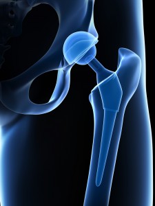 Hip Implant